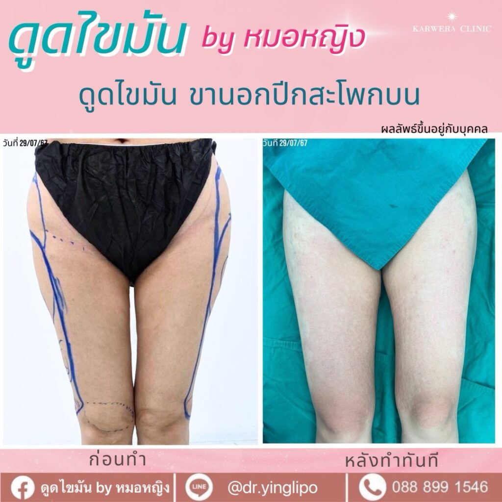รีวิวดูดไขมันสะโพก แก้ปัญหาสะโพกใหญ่ ขาเบียด