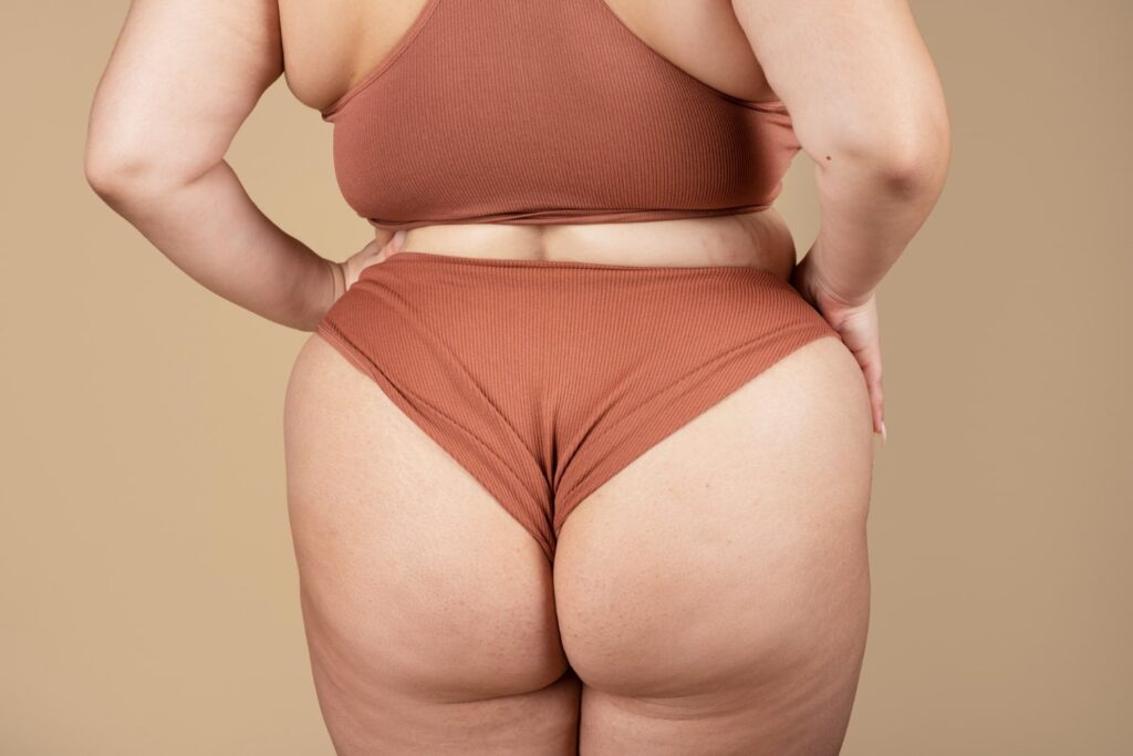 สะโพกใหญ่ พุงห้อย เอวปลิ้นเป็นชั้น! แก้ได้ด้วยการดูดไขมันลดสะโพก กระชับสัดส่วน